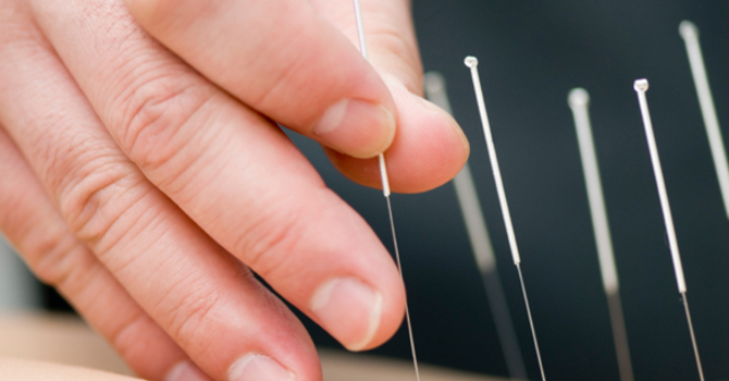 Acupuncture For Arthritis image